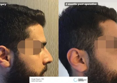 לפני ואחרי ניתוח אף תוצאות לאחר 3 חודש