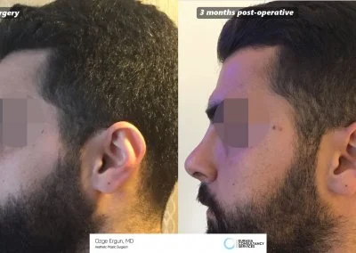 לפני ואחרי ניתוח בן 27
