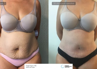 לפני ואחרי ניתוח מתיחת בטן אישה בת 42