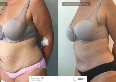 לפני ואחרי ניתוח מתיחת בטן אישה בת 42 לאחר 50 יום
