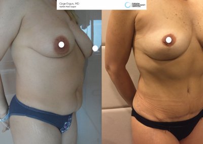 לפני ואחרי ניתוח מתיחת בטן אישה בת 45 בטורקיה
