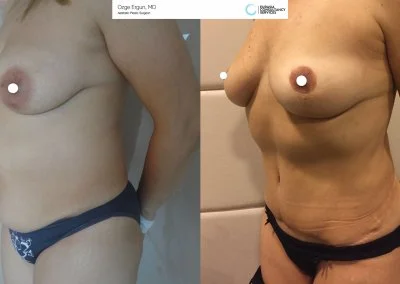 לפני ואחרי ניתוח מתיחת בטן אישה בת 45 באיסטנבול