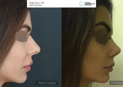 לפני ואחרי ניתוח אף בטורקיה חודש לאחר הניתוח