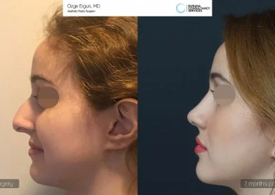 לפני ואחרי ניתוח אף בטורקיה אישה בת 25