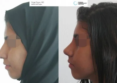 לפני ואחרי ניתוח אף בטורקיה איסטנבול אישה בת 24