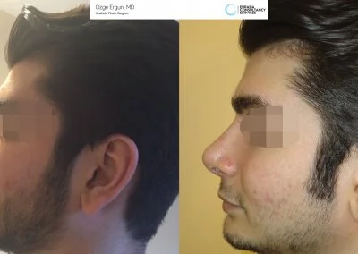 לפני ואחרי ניתוח אף בטורקיה בן 25