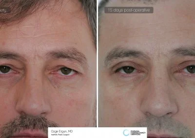 לפני ואחרי ניתוח הרמת עפעפיים לאחר 15 ימים