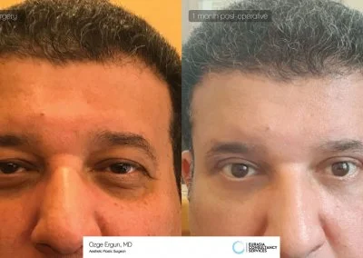 לפני ואחרי ניתוח הרמת עפעפיים לאחר חודש
