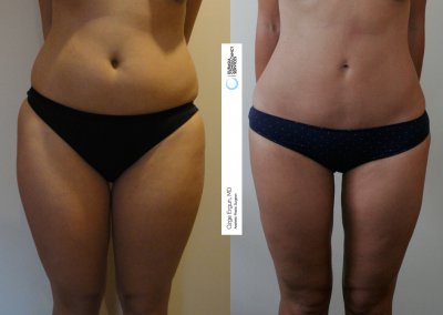 שאיבת שומן לפני ואחרי תמונה נוספת 2