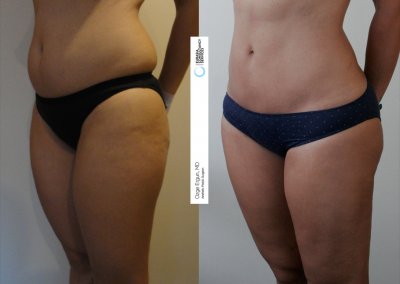שאיבת שומן לפני ואחרי מהבטן תמונה נוספת