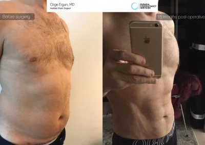 שאיבת שומן לפני אחרי 6PACK