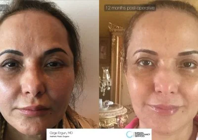 לפני ואחרי ניתוח מתיחת פנים בטורקיה לאחר שנה של תוצאה